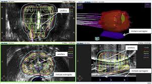Decreased force in the stream of urine. Shorter Radiotherapy Courses Safe And Effective For Prostate Cancer Imaging Technology News
