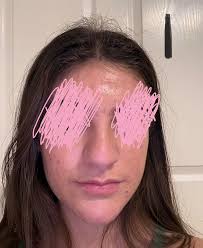 Hi everyone! I had my nose operation