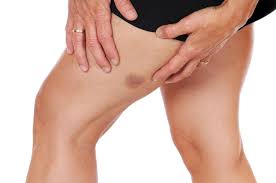 Meistens werden sie durch stürze, stöße. Hamatom Ursachen Risikofaktoren Hilfe Bei Blauen Flecken