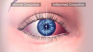 Conjunctivitis