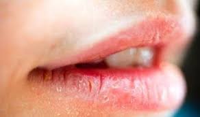 Levres Seches Et Gercees Baume A Levres Maison A Base Du Beurre De Karite Dry Lips Swollen Lips Swollen Lip Remedy