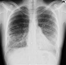 Lymphangioleiomyomatosis Radiology Reference Article Radiopaedia Org