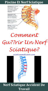 Pin On Sciatique Que Faire Sciatique