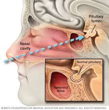 Transnasal Transsphenoidal Surgery Pituitary Gland Tumor Tumor Diagnosis