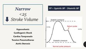 Image result for Pulse Pressure