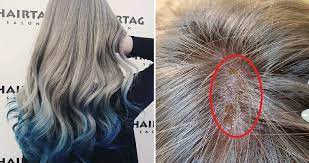 Reaction to a hair care product. Girl Suffers Chemical Burns On Scalp After Salon Leaves Bleach On For 3 Hours World Of Buzz