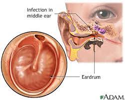 Ear Infection - Chronic: Medlineplus Medical Encyclopedia