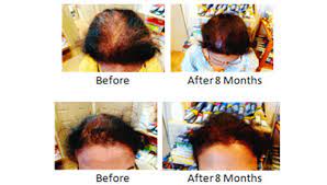Can acupuncture be used to treat hair fall? Female Hair Loss Treatment And Natural Hair Regrowth