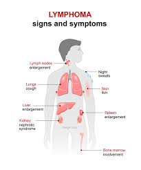 Image result for Lymphoma