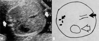 Assessment Of Gestational Age By Ultrasound Glowm
