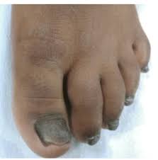 Image result for Pitting nails feet