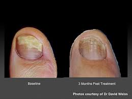 nail laser fungus infection