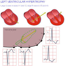 Image result for R Wave