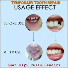 Jangan dipakai ke gigi berlubang yg lubangnya tidak beraturan,karena bakal susah hanya untuk membuat gigi palsu dan menambah gigi patah atau ompong sebagian. Jual Berkualitas Temptooth Buat Gigi Palsu Sendiri Bisa Dipakai Untuk Jakarta Barat Garuda Sopes Tokopedia