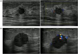 The use of ultrasound for breast cancer screening. Machine Learning For Diagnostic Ultrasound Of Triple Negative Breast Cancer Springerlink