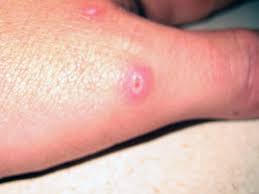 Likewise, you should know what the spider looks like. Spider Bites Identification And Treatment