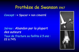 Последние твиты от swanson tool company (@swansontoolco). Ppt Historique Des Protheses Totales De Poignet Powerpoint Presentation Id 4634023