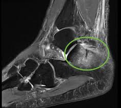 Image result for Calcaneus Compression Fracture