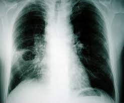 Image result for Lung Abscess