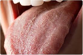 Image result for oral thrush symptoms roof of the mouth