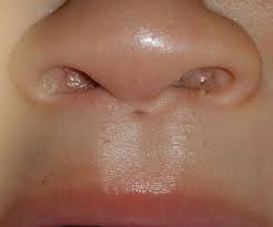 Median Philtrum Sinus A Rare Presentation And Review Of Management Options Bmj Case Reports Information and translations of philtrum in the most comprehensive dictionary definitions resource on the web. median philtrum sinus a rare