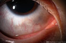 Image result for melanosis sclera