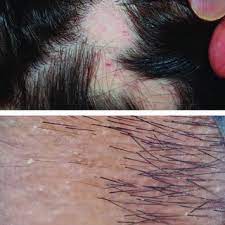 Learn how long tretinoin side effects last and how to safely apply it. Pdf Retinoids In Hair Disorders