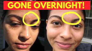 Reduce Pimple Redness Overnight How To Reduce Pimples Reduce Pimple Redness Acne Redness