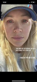 Krystal thought she was having intense allergies but it was actually a  chemical reaction from her hair appointment