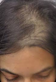 Pregnancy is one of the most common sources of temporary hair loss in women. Female Hair Loss Scalpclub