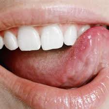 Tongue With Canker Sores Canker Sore Tongue Sores Blister On Tongue
