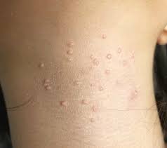 But most cases get better you can spread molluscum contagiosum: Bubble Trouble Clinician Reviews