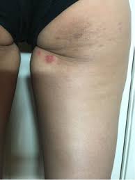 People may notice herpes symptoms across the body, including in the mouth, on the genitals, or in the eyes. View Of Multiple Recurrences Of Hsv 1 On Right Lower Buttock The Southwest Respiratory And Critical Care Chronicles