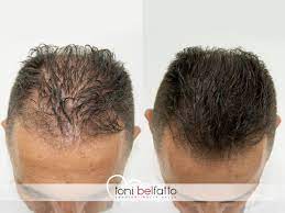 Tricopigmentazione per la caduta dei capelli: Tricopigmentazione Latina Milano Napoli Roma Pescara