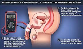 Scientists Reckon They've Got A Cure For Premature Ejaculation.. But It  Involves Zapping The Penis | Daily Mail Online