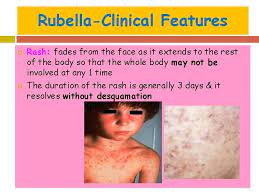 Translated from english into russian by. Common Viral Exanthemas Measles Chickenpox Rubella Dr Sarika
