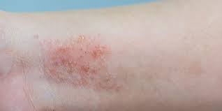 Check spelling or type a new query. Wajib Tahu Cara Hindari Pemicu Kulit Kering Dan Gatal Akibat Eksim