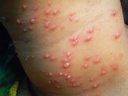 Padahal, kedua penyakit tersebut menyebabkan ruam. The Journey My Everyday Is Busyday With Kids Husband Family Friends And Workstation Petua Rawat Demam Campak Besar Chicken Pox