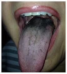 Image result for black hairy tongue symptoms