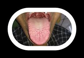 Image result for Fissured tongue