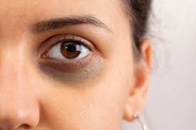 Dark Circles Under Eye Treatment - Surrey Laser & Spa Skincare Clinic
