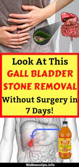 See Gall Bladder Stone Removal Without Surgery In 7 Days Gallbladder Rsm Gallbladder Cleanse Gallbladder Gallbladder Flush