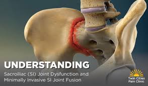 Image result for Sacroiliac Dysfunction