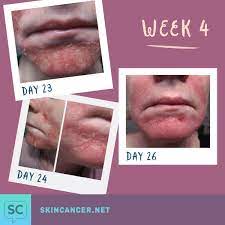 These differences mean that anti metabolites stop cancer cells working properly. Mohs Surgery Pictures Post Op Photos Of The Body