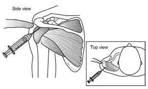 Shoulder impingement syndrome is the result of a vicious cycle of rubbing of the rotator cuff between your humerus and top outer edge of your shoulder. Shoulder Impingement Rotator Cuff Tendinitis Orthoinfo Aaos