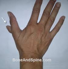 Image result for Supernumerary Digit