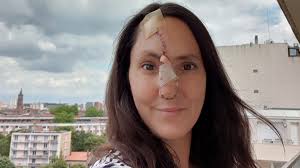 Image result for skin cancer on nose pimple