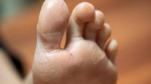 Tips For Managing Foot Psoriasis Everyday Health