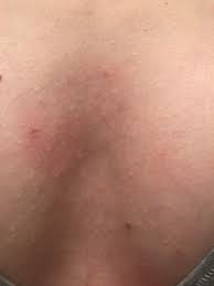 This just started happening a few days ago. I Have All These Little White Bumps On My Chest Not Itchy Or Painful I Sometimes Get Chest Acne Besides This I Ve Tried Benzoyl Peroxide And Clindamycin And Salicylic Acid I Also