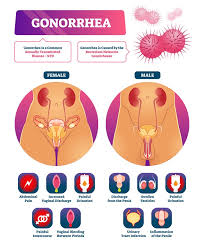 Image result for gonorrhea symptoms